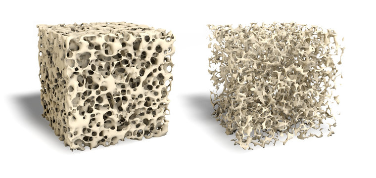 Healthy bone and osteporosis bone (right side)