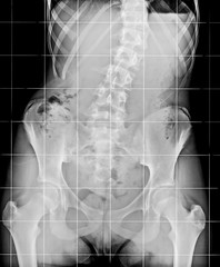 X-ray of the Spinal Column and Pelvis of human skeleton