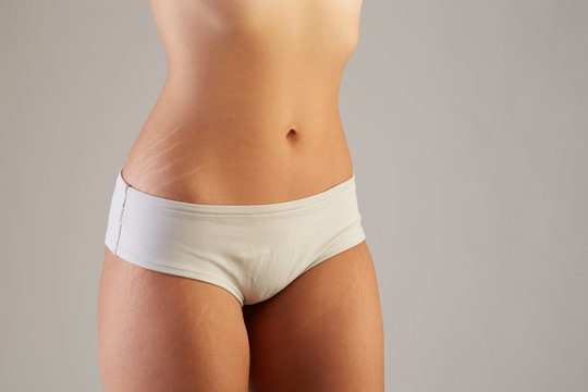 Unretouched skin exhibits stretch marks and other imperfections.