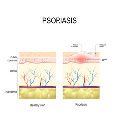  Healthy skin close up and skin with the plaque psoriasis - obrazy, fototapety, plakaty