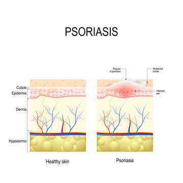  Healthy skin close up and skin with the plaque psoriasis
