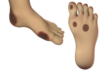 Diabetic foot ulcer, 3D illustration showing common location of diabetic ulcer lesions - obrazy, fototapety, plakaty