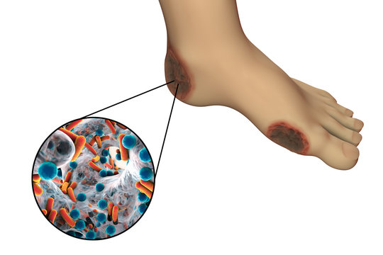 Diabetic Foot Infection With Close-up View Of Bacteria