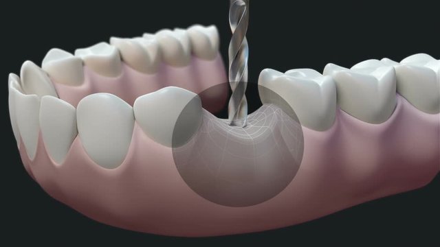 Dental Implant Dark. High quality animation 3D showing the installation process of dental implants.