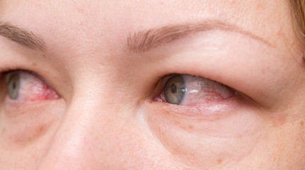 red eyes