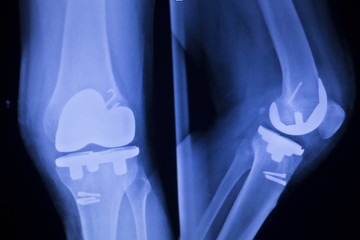 Knee joint implant xray