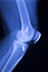 Knee joint implant xray