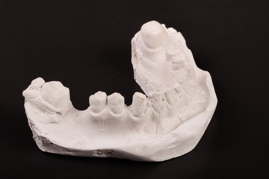 plaster cast of teeth with removable partial denture on a dark background