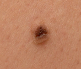 a mole on the skin