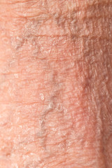varicose veins on the skin