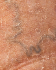 Fototapeta premium varicose veins on the skin