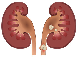 Nephrolithiasis kidney stones disease