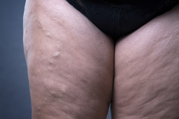 Varicose veins closeup, thick female legs