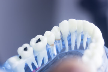 Fototapeta na wymiar Dental teeth decay plaque model