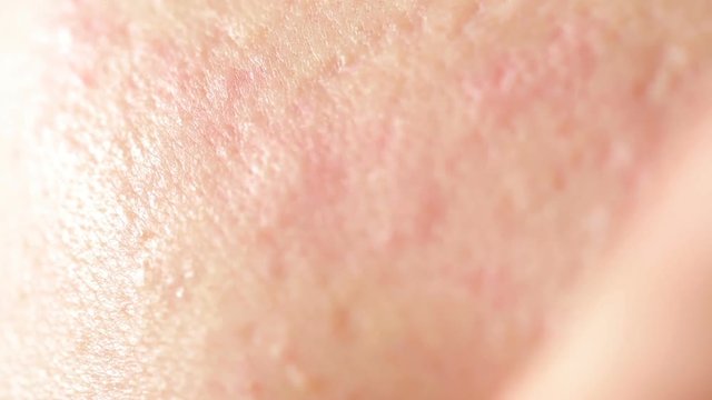 spherical cystic acne on the skin. Close-up. The concept of dermatology