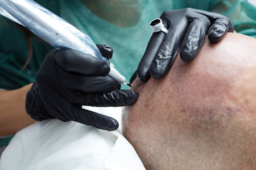 Cosmetologist making permanent makeup on male skin head - tricopigmentation applying
