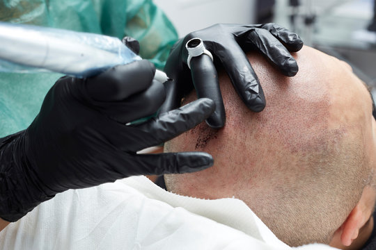 Cosmetologist making permanent makeup on male skin head - tricopigmentation applying