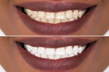 Woman Teeth Before And After Whitening