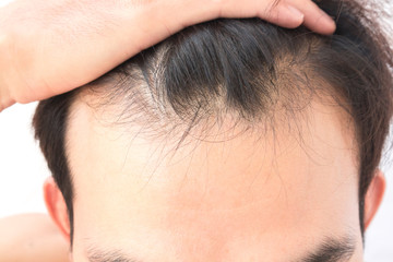 Young man serious hair loss problem for health care shampoo and