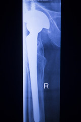 Hip joint replacement xray