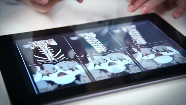 Doctor Examines An X-ray Of The Spine On Tablet Screen