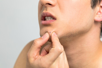 young man squeezing a pimple, men's skincare concept