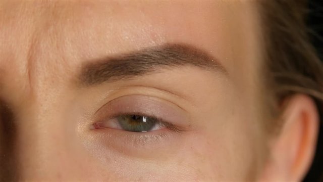 Girl opens her eyes and her eyes are very sore and swollen. Close up