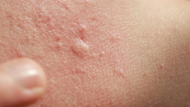 spherical cystic acne on the skin. Close-up. The concept of dermatology