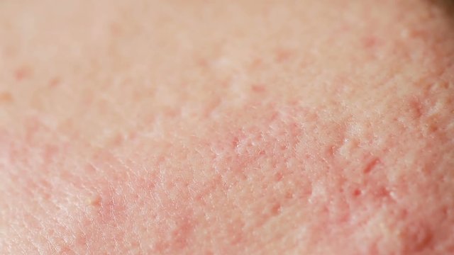 spherical cystic acne on the skin. Close-up. The concept of dermatology