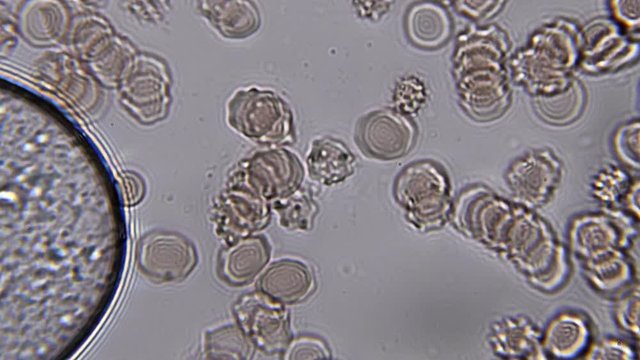 Footage on the theme blood, diseases, interstitial fluid, bacterial background, research using a microscope at extreme magnification of about 1000x
