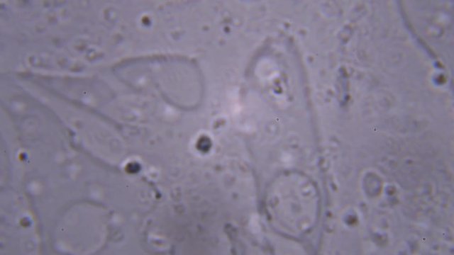 Analysis of the male sperm, the search for active sperm for diagnosis. One was found, using a microscope at extreme magnification of about 1000x - there is hope :)