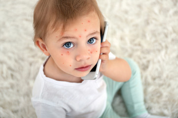Little girl with red pimples at home. Chicken pox concept