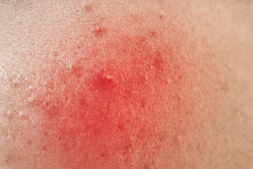 Acne treatment concept. Skin irritation, closeup