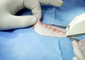 Veterinaian and surgeon stitch up te wound of dog using skin stapler