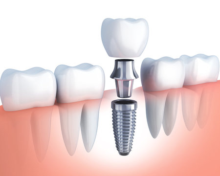 row tooth and Dental implant