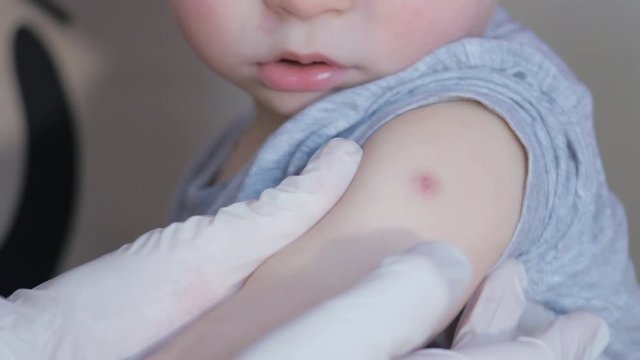 The doctor checks the child's hand after vaccination with BCG. Doctor in white gloves. The doctor checks the child's hand on a vaccine reaction