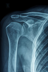 X-ray film of primary frozen shoulder or adhesive capsulitis of Asian female patient 