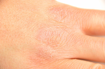 hand with very dry skin