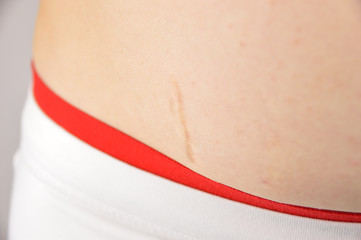 strecht marks on my belly