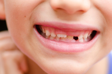 Close up smiling child mouth missing milk teeth