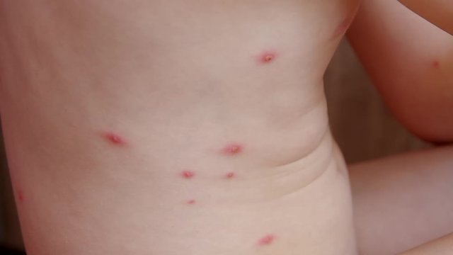 Chickenpox on the body of 5 year old girl
