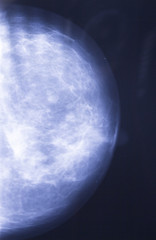 Xray of breast with tumor