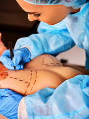 Breast surgery of body part. Implants for surgery augmentation. Doctor makes dotted line on female body on black background. Top view and close up of nipple. Female beautiful and healthy.