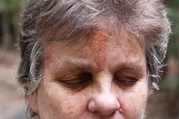 Mature woman with eyes closed showing bruises