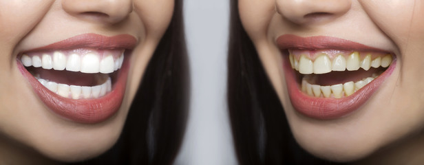 Obraz premium Wybielanie zębów, opieka stomatologiczna, usługi dentystyczne na porównanie przed i po. Białe zęby i żółte zęby z płytką w ustach kobiet z uśmiechem. Radość po dentystach. Udana procedura zdrowotna