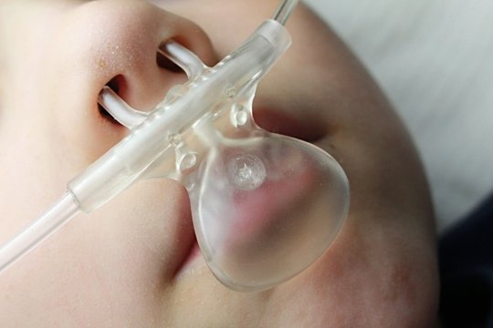 Capnography ETCO2 monitoring line on nose and mouth of small boy