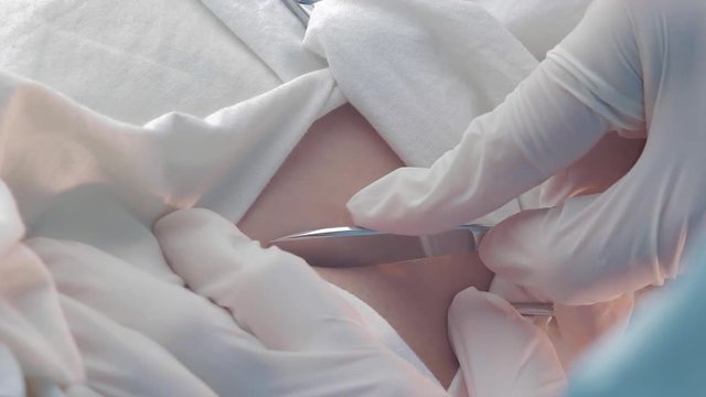 Close-up, Scalpel in surgeon's hand before the surgical incision. The patient is in the operating room, under anesthesia.