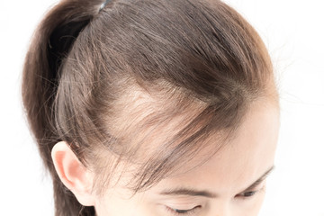 Woman serious hair loss problem for health care shampoo and beau