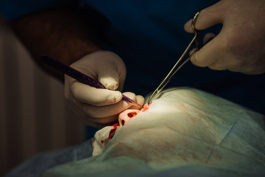 surgeon putting on stitches during cosmetic plastic surgery 