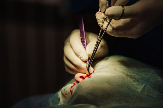 surgeon putting on stitches during cosmetic plastic surgery